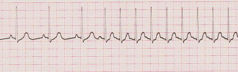 ecg rhythm strip for quiz