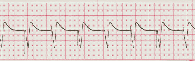 ecg rhythm strip for quiz