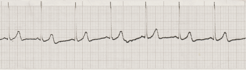 ecg rhythm strip for quiz