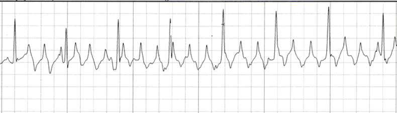 ecg rhythm strip for quiz