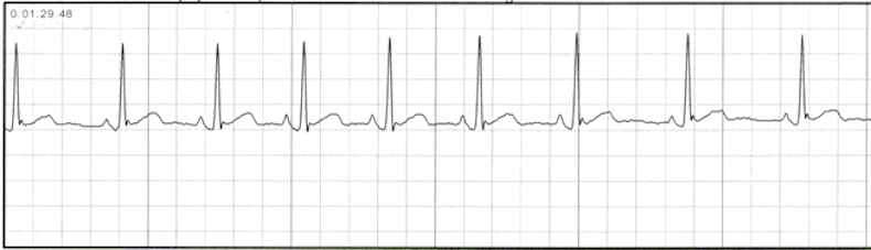 Essential EKGs For Nurses | Multiple Choice Graded Quiz