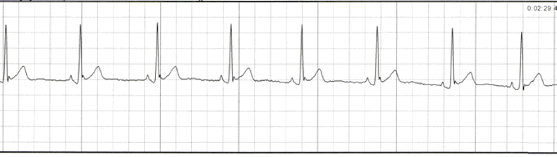 Comprehensive ECG Quiz | Multiple Choice Graded Quiz