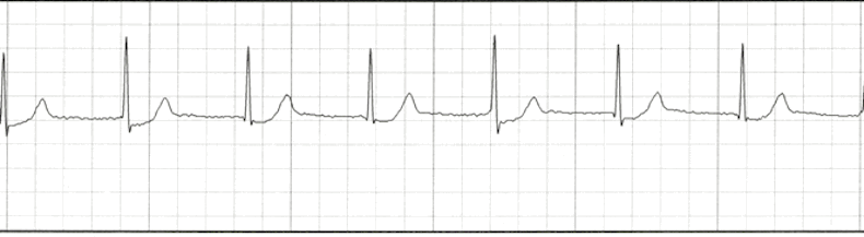 ecg rhythm strip for quiz