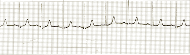 ecg rhythm strip for quiz