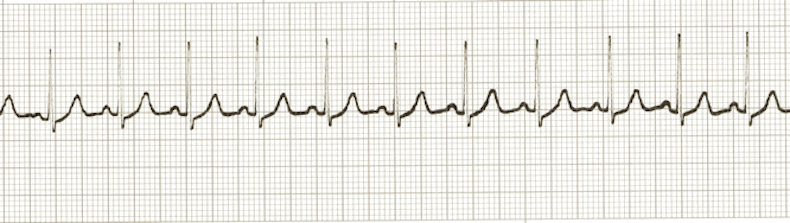 ECG Practice Drill