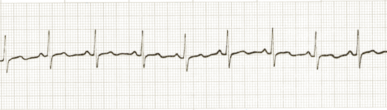 ecg rhythm strip for quiz