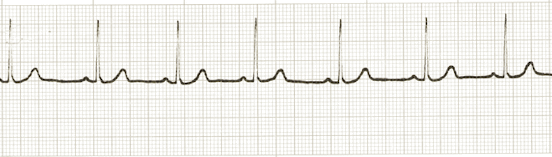 ecg rhythm strip for quiz