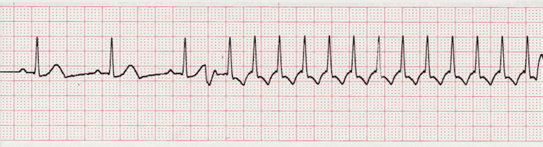 ECG Practice Drill