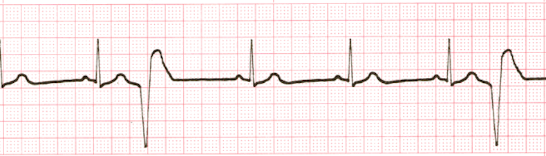 ECG Practice Drill