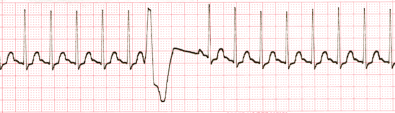 ecg rhythm strip for quiz