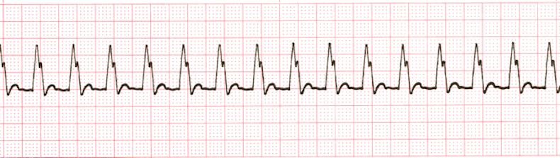 ecg rhythm strip for quiz