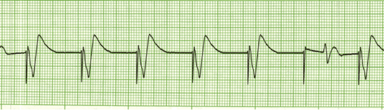 ecg rhythm strip for quiz