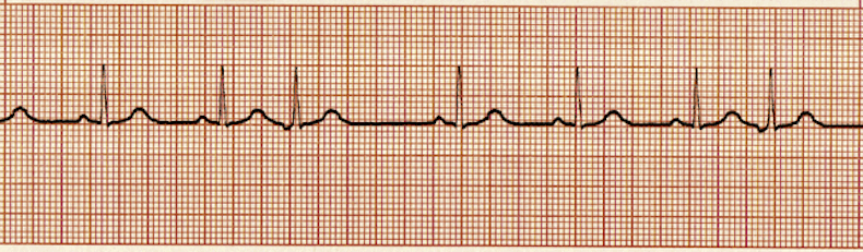 EKG - Estos ejercicios prácticos 