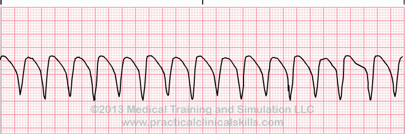 Ventricular Tachycardia Monomorphic EKG tracing