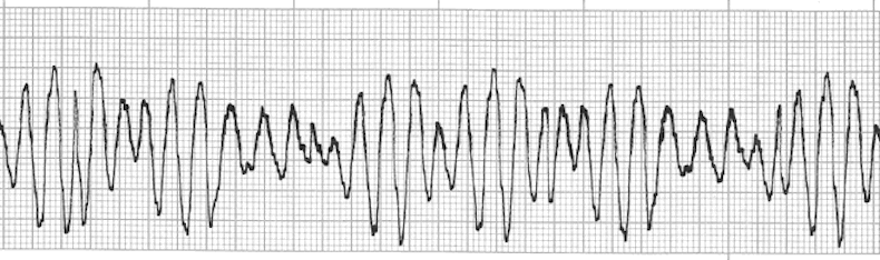 ecg rhythm strip for quiz