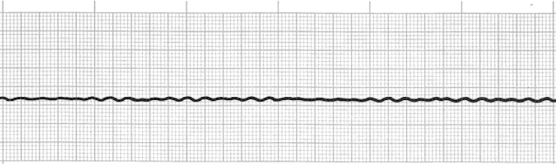 ecg rhythm strip for quiz