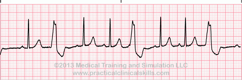 Premature Ventricular Complex - Trigeminy EKG tracing