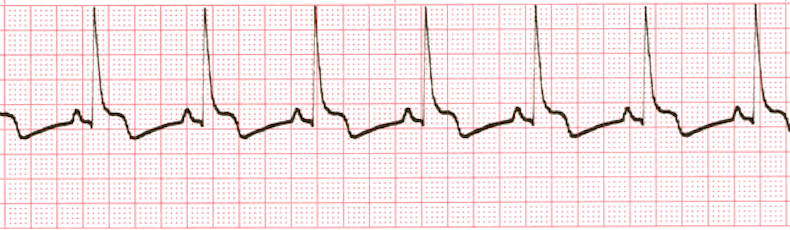 ECG Practice Drill