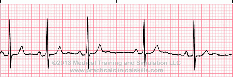 Sinus Arrhythmia EKG tracing