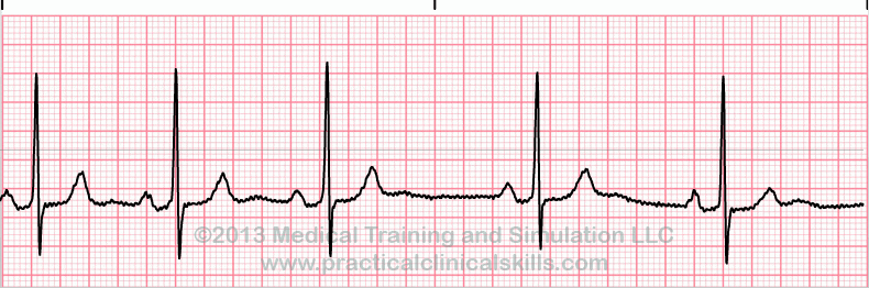 ecg rhythm strip for reference guide