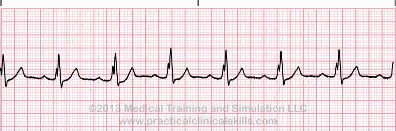 Essential EKGs for Nurses | Multiple Choice Graded Quiz