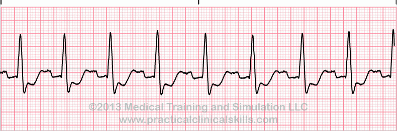 ekg rhythm strip for reference guide