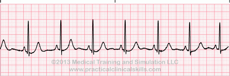 normal sinus rhythm EKG tracing