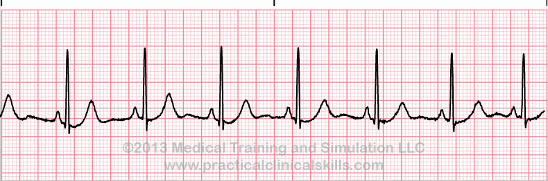 sinus rhythm ECG tracing