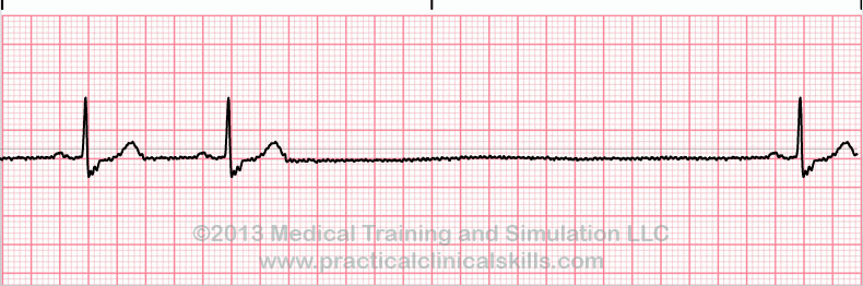 sinus rhythm EKG tracing