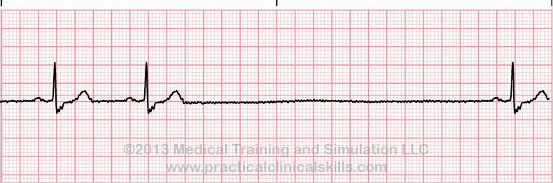 ecg rhythm strip for reference guide