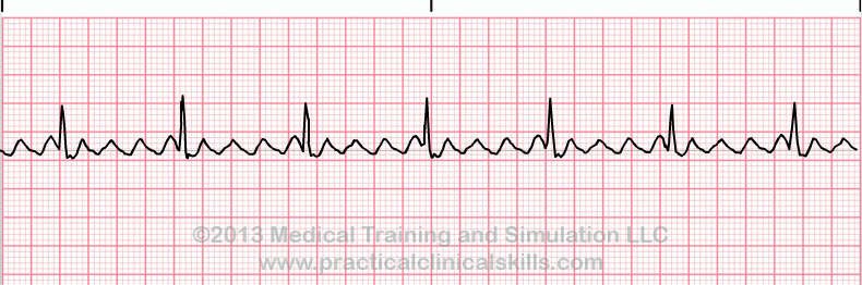 Atrial Flutter EKG Interpretation with Rhythm Strip