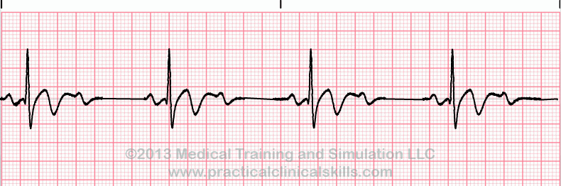 ecg rhythm strip for quiz