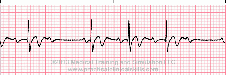 ECG Practice Drill