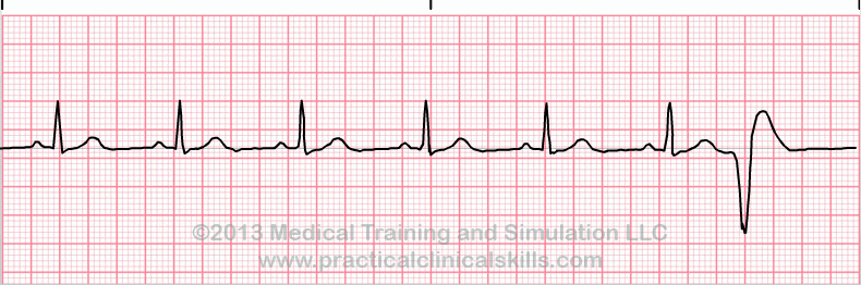 Premature Ventricular Complex EKG tracing
