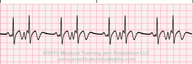 ecg rhythm strip for reference guide