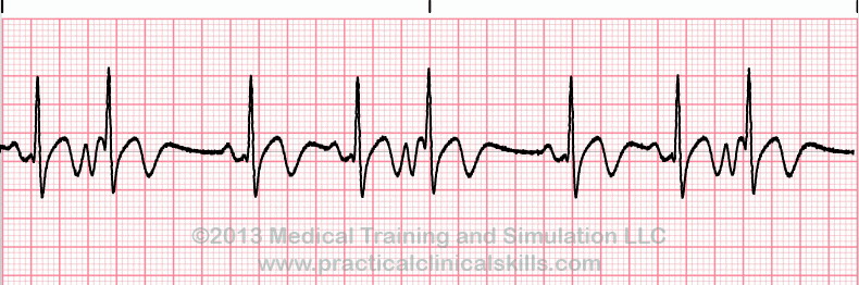 ECG Practice Drill